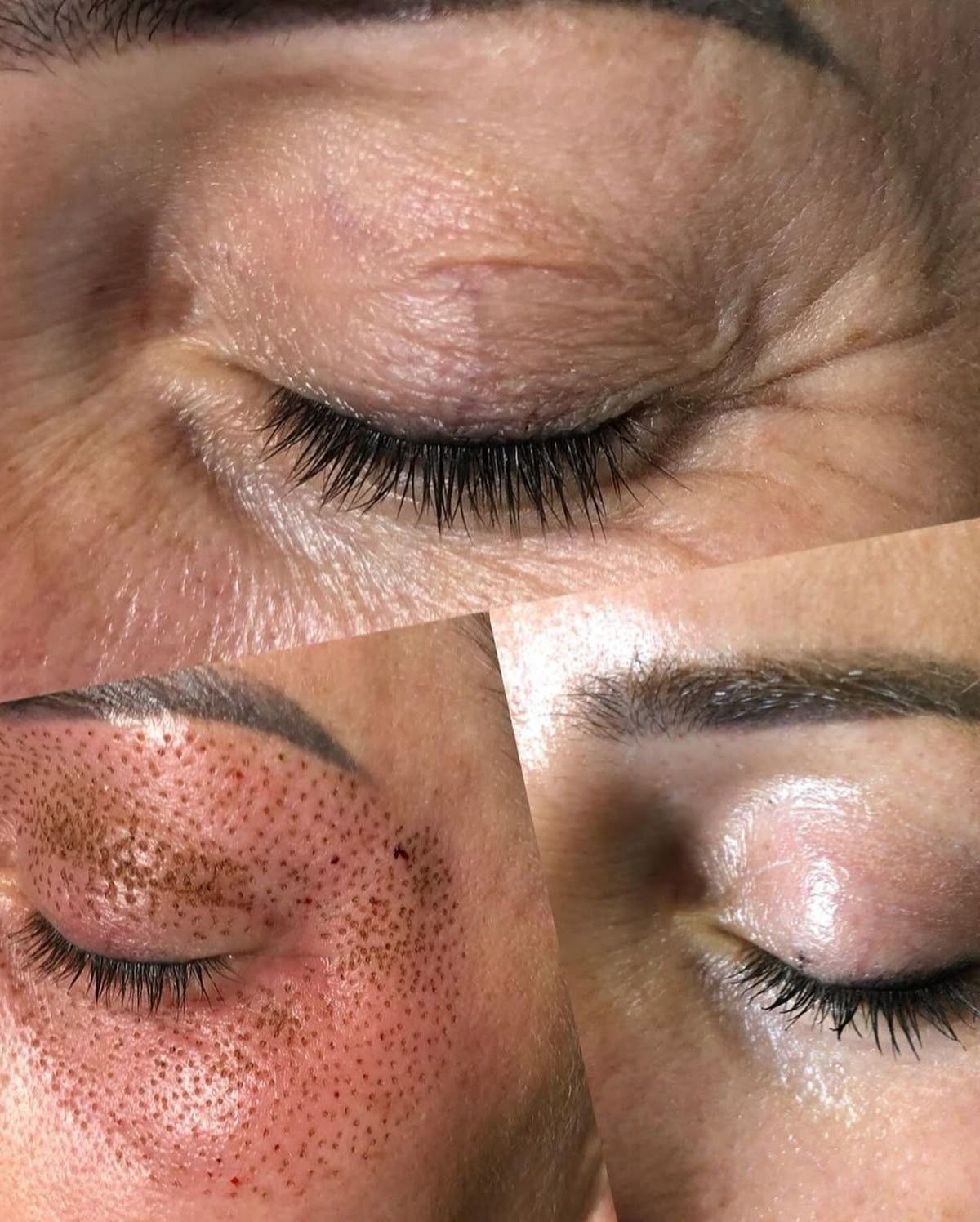 Plasmapen fibroplast (eliminación de arrugas)