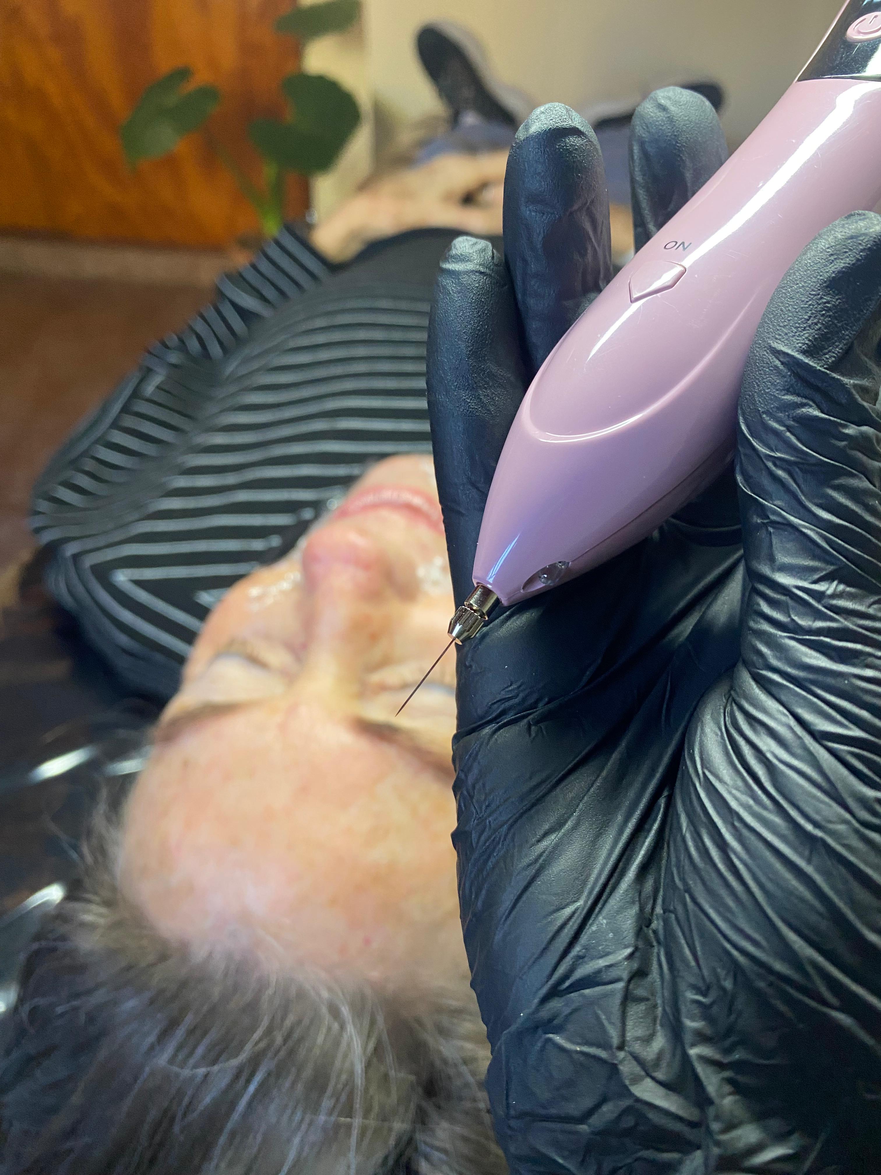 Plasmapen fibroplast